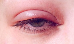 Viêm bờ mi mắt cần chăm sóc như thế nào?