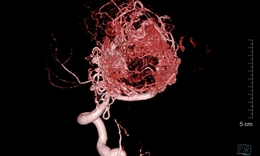 Cứu sống nam sinh 16 tuổi mắc dị dạng mạch m&#225;u n&#227;o phức tạp