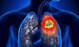 Ung thư phổi đau ở đ&#226;u, dấu hiệu cảnh b&#225;o căn bệnh n&#224;y