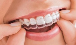 Loại mắc c&#224;i n&#224;o tốt nhất để niềng răng?