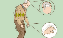 Biểu hiện cho thấy bạn mắc bệnh Parkinson