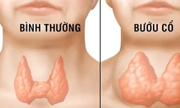 Thiếu i-ốt gây hại như thế nào?