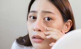 Quầng thâm dưới mắt – Cảnh báo thiếu hụt chất dinh dưỡng nào?