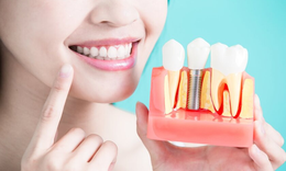 Chăm s&#243;c nướu sau implant: Bảo vệ răng từ gốc