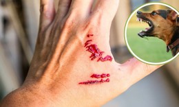 Xử tr&#237; vết thương đ&#250;ng khi bị ch&#243;, m&#232;o cắn để ph&#242;ng bệnh dại
