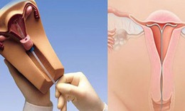Tr&#225;nh thai nội tiết c&#243; thực sự tốt cho phụ nữ?