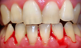 H&#224;nh tr&#236;nh &#39;giải cứu&#39; nướu vi&#234;m: Từ thảo dược tự nhi&#234;n đến liệu ph&#225;p chuy&#234;n s&#226;u