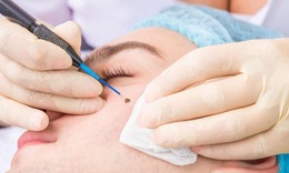 Đốt nốt ruồi nhiều lần, người đàn ông bất ngờ nhận tin dữ