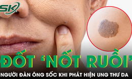 Li&#234;n tục đốt ‘nốt ruồi’ kh&#244;ng hết, người đ&#224;n &#244;ng trẻ sốc khi ph&#225;t hiện mắc ung thư da
