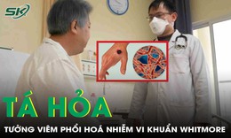 Tưởng vi&#234;m phổi, người đ&#224;n &#244;ng t&#225; hỏa ph&#225;t hiện nhiễm vi khuẩn Whitmore