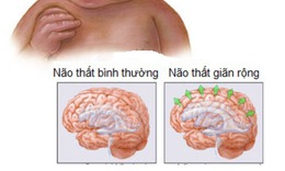 Phát hiện sớm não úng thủy ở trẻ nhỏ