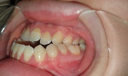 Điều trị m&#243;m (khớp cắn ngược) do xương h&#224;m
