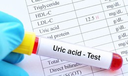 Người bị tăng acid uric cần lưu &#253; g&#236; để ph&#242;ng ngừa gout hiệu quả?
