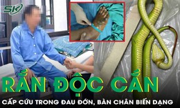 Bàn chân biến dạng, sưng nề dữ dội vì rắn lục xanh tấn công