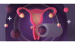 C&#225;c yếu tố l&#224;m tăng nguy cơ nhiễm HPV g&#226;y ung thư cổ tử cung