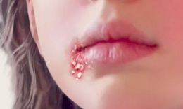 C&#244; g&#225;i hoảng hốt ph&#225;t hiện mắc s&#249;i m&#224;o g&#224; sau khi ‘y&#234;u bằng miệng’ 