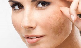 Uống g&#236; để đẹp da, giảm n&#225;m cho phụ nữ sau tuổi 30?