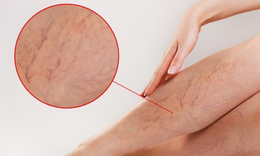 Suy giãn tĩnh mạch tiến triển: Đừng chủ quan với những dấu hiệu ban đầu