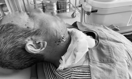 Su&#253;t mất mạng v&#236; tự &#253; đi đốt nhiệt khi đau răng