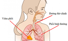 Vi&#234;m phổi ở trẻ em: C&#225;ch nhận biết sớm v&#224; ph&#242;ng tr&#225;nh