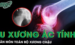 Hi hữu khối u xương &#225;c t&#237;nh ăn m&#242;n to&#224;n bộ xương chậu 