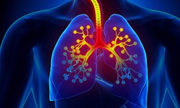 Những nguy&#234;n nh&#226;n g&#226;y phế quản co thắt 