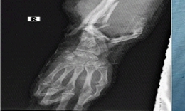 Thai phụ song thai 23 tuần được gh&#233;p b&#224;n tay v&#224;o cẳng ch&#226;n đ&#227; c&#243; thể đi lại