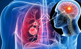 5 bí quyết phòng ngừa ung thư phổi cần biết