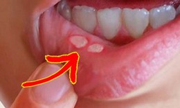HIV ảnh hưởng đến sức khỏe răng miệng như thế nào?