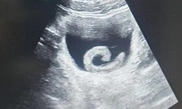 Người đàn ông phải nhập viện cấp cứu vì… đỉa sống trong bàng quang