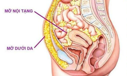 6 điều bạn nên làm để giảm mỡ nội tạng hiệu quả, bền vững