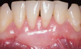 Những điều nên và không nên sau ghép lợi