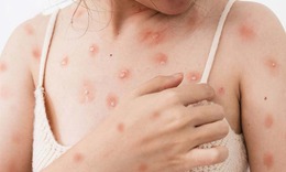 Cảnh báo thủy đậu ở người lớn có thể gây biến chứng nguy hiểm
