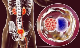 3 bệnh lây truyền qua đường tình dục làm tăng nguy cơ ung thư cổ tử cung