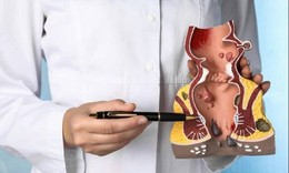 Trĩ nội độ 2 có cần mổ không?