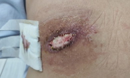 Người phụ nữ bị hoại tử lưng vì điều trị mụn nhọt theo phương pháp truyền miệng