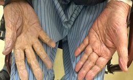 Hút nhiều cục máu đông cứu cụ ông 97 tuổi khỏi nguy cơ cắt cụt tay