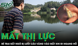 Đi ngang hồ câu, bé trai bất ngờ bị lưỡi câu văng vào mắt và có nguy cơ mất thị lực vĩnh viễn
