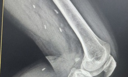 
Phát hiện nhiều kén sán ở chân bệnh nhân do một thói quen thường gặp