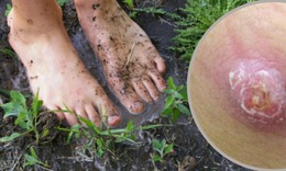 Hiếm gặp, áp xe tinh hoàn do bệnh Whitmore: Cảnh báo nguy cơ phải cắt bỏ tinh hoàn