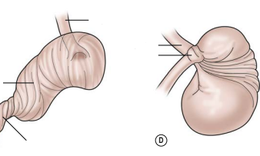 Xoắn dạ dày ở trẻ em rất nguy hiểm, cha mẹ cần phát hiện sớm