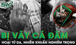 Người đàn ông nhiễm khuẩn, hoại tử da nghiêm trọng sau khi bị vây cá đâm