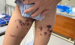 Bé trai bỏng nặng tầng sinh môn do nước tẩy bồn cầu bắn vào người