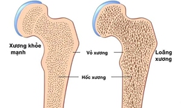 5 biện pháp giúp xương chắc khỏe, giảm nguy cơ loãng xương