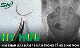 Kim khâu gãy bị bỏ sót, nằm 11 năm trong tầng sinh môn người phụ nữ