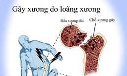 Điều chỉnh thói quen và dinh dưỡng, cải thiện sức khỏe xương khớp