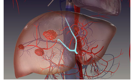 Đau tức hạ sườn, ăn kém, sút cân… cảnh giác với u máu gan