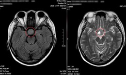 Nhìn mờ kéo dài, người phụ nữ phát hiện u tuyến yên nhờ khám mắt