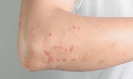 Nhiều trường hợp ở Khánh Hòa bị giun đũa chó mèo, người dân chủ động phòng bệnh