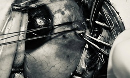 Bảo tồn nhãn cầu cho bệnh nhân bị đinh sắt bắn vào mắt